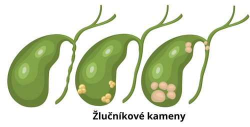 Žlučníkové kameny